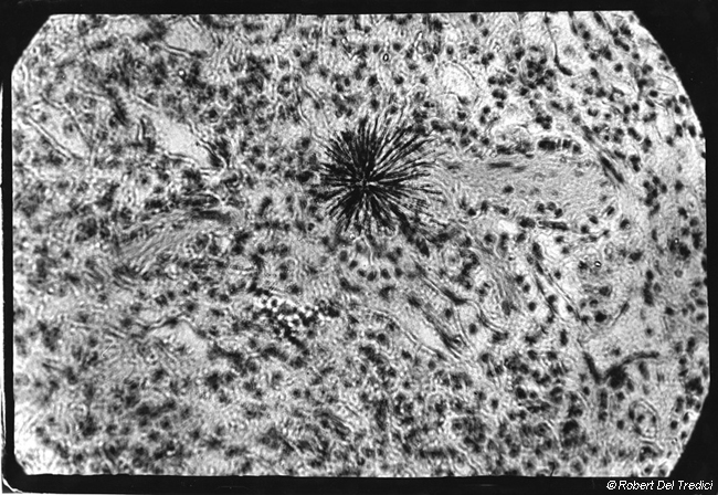 D5. Particle of Plutonium in Lung Tissue. D5. Particle of Plutonium in Lung Tissue.